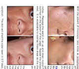 Non Surgucal Skin Lightening Non Laser Treatment Machine & Microlysis Gel Kit.