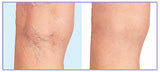 Spider & varicose vein treatment removal machine for legs, face, nose, best for women & men.
